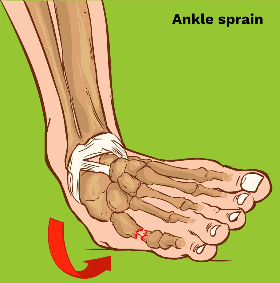 sprain
