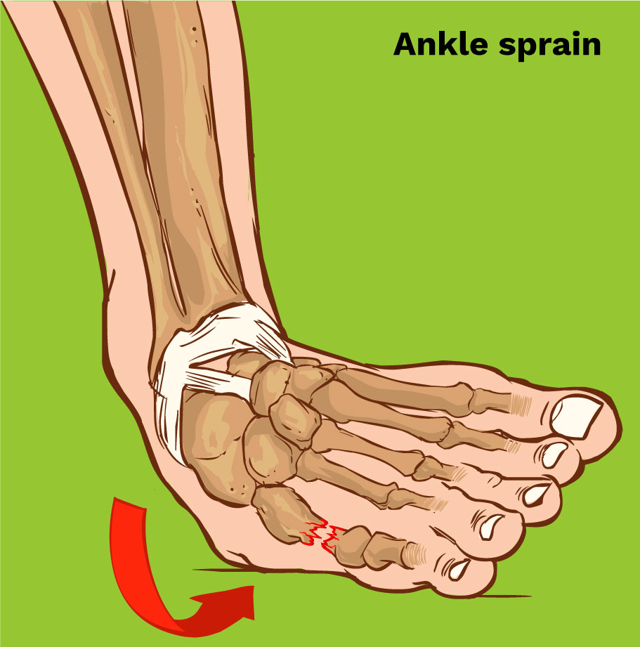 Don't Spiral into an Ankle Sprain — Valley Stream Podiatry